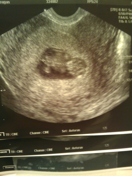 First ultrasound at 10 weeks with Dr. Ramos. Our little one has a strong heartbeat and is already drilling hip escapes by moving around in there. Grow strong little one! Mom & Dad love you!